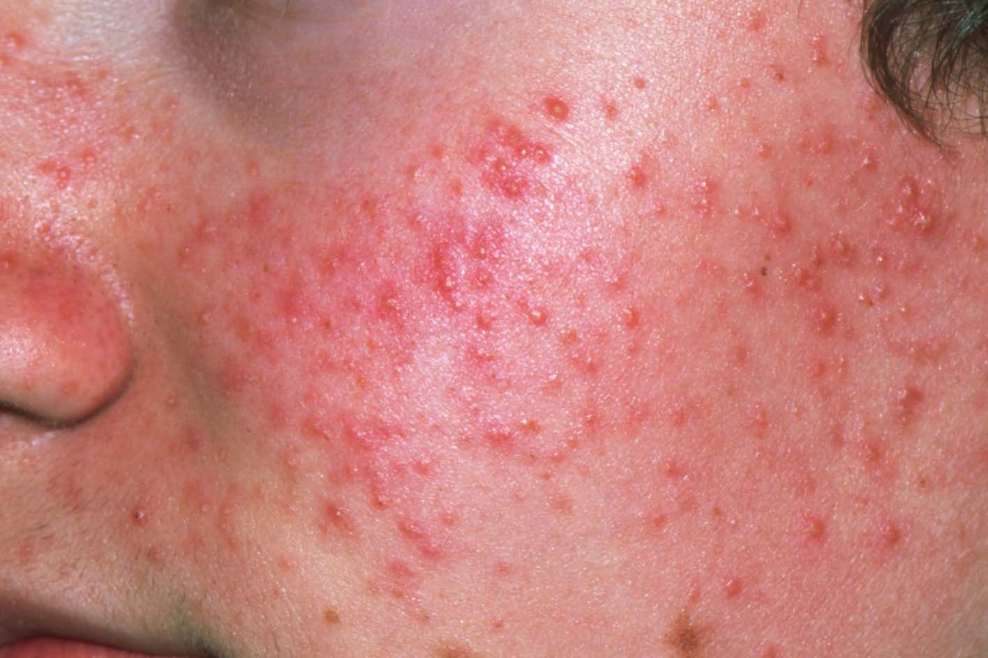 Acne (Private)
